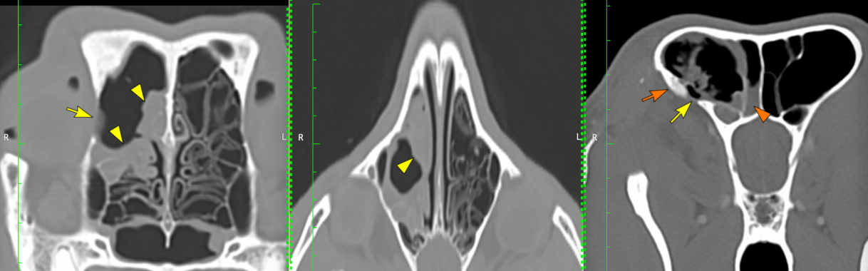 Diagnosis and Treatment of Canine Sinonasal Aspergillosis